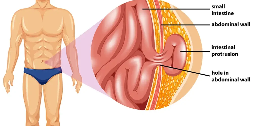 hernia repair