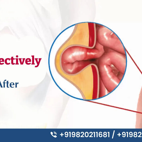 Hernia Surgery In Mumbai