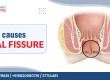 What Causes Anal Fissure