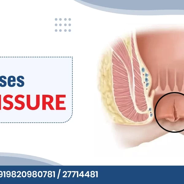 What Causes Anal Fissure