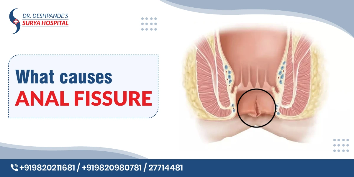 What Causes Anal Fissure
