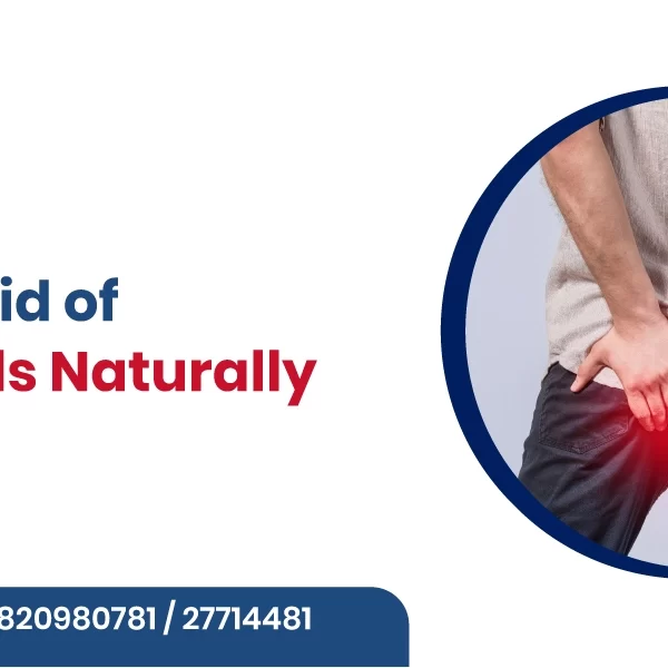 How to Get Rid of Hemorrhoids Naturally