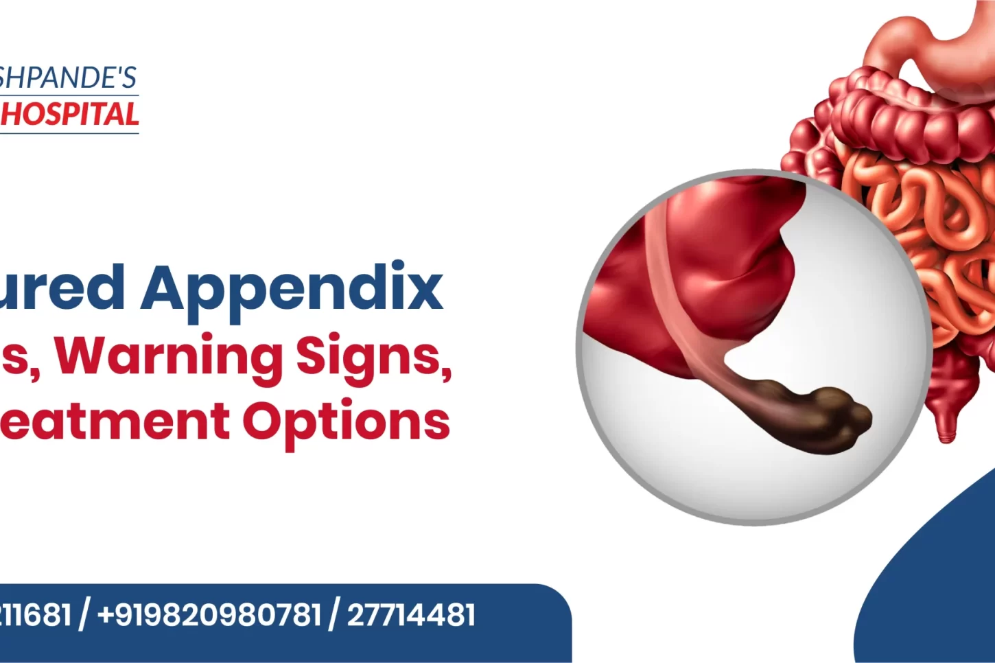 Ruptured Appendix: Causes, Warning Signs, and Treatment Options
