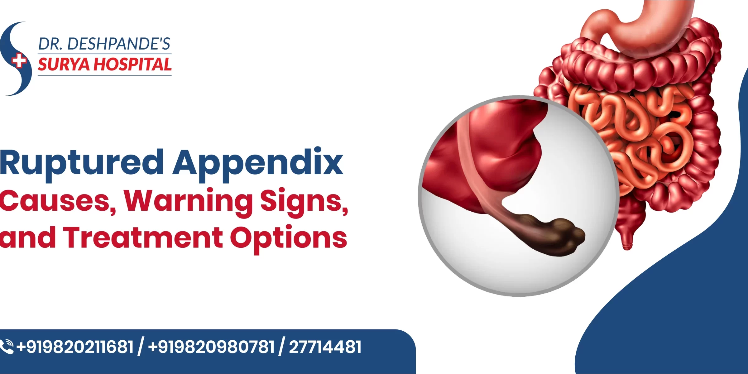 Ruptured Appendix: Causes, Warning Signs, and Treatment Options