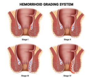 Hemorrhoig grades