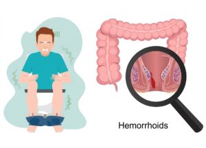 Hemorrhoids treatment in navi mumbai