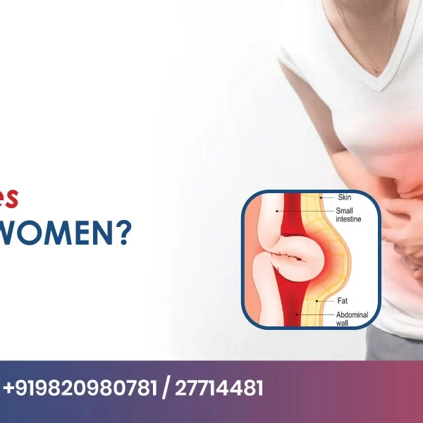 What Causes a Hernia in Women What Causes a Hernia in Women